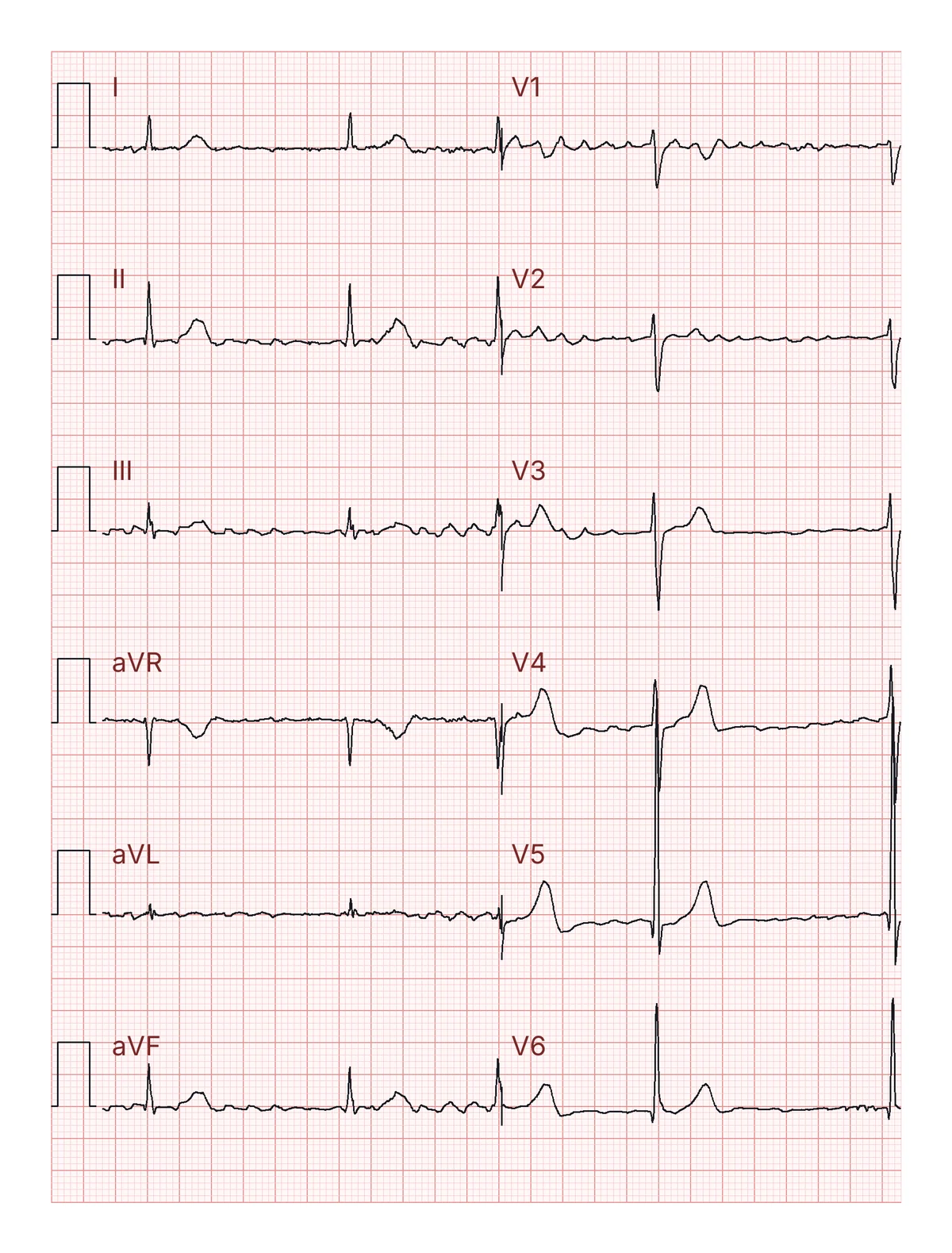 Un ECG 12&nbsp;d&eacute;rivations sans aucune explication